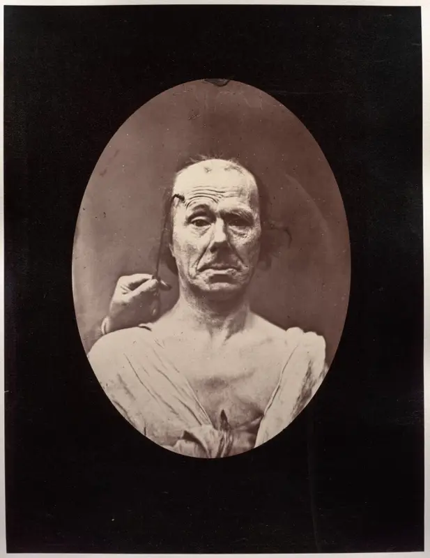 Figure 7: Étude du méchanisme et de l'expression du muscle frontal chez un vieillard: à droit, attention; à gauche, repos — تصویر رکورد موزهٔ هنر کلیولند (دسترسی آزاد)