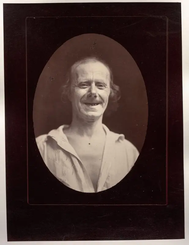 Figure 32: Natural laughter by the voluntary contraction of the two large zygomatics and the lower palpebral orbicularis — تصویر رکورد موزهٔ هنر کلیولند (دسترسی آزاد)